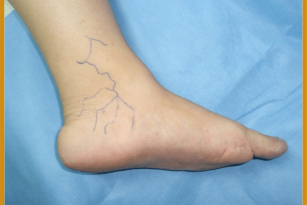 Dolor en la planta de pie