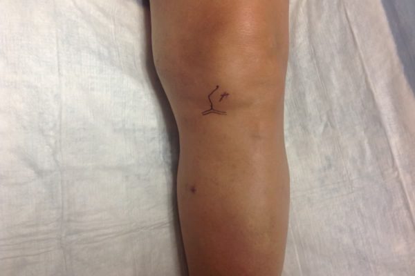 Dolor en hueco popliteo (parte posterior de la rodilla) origen venoso